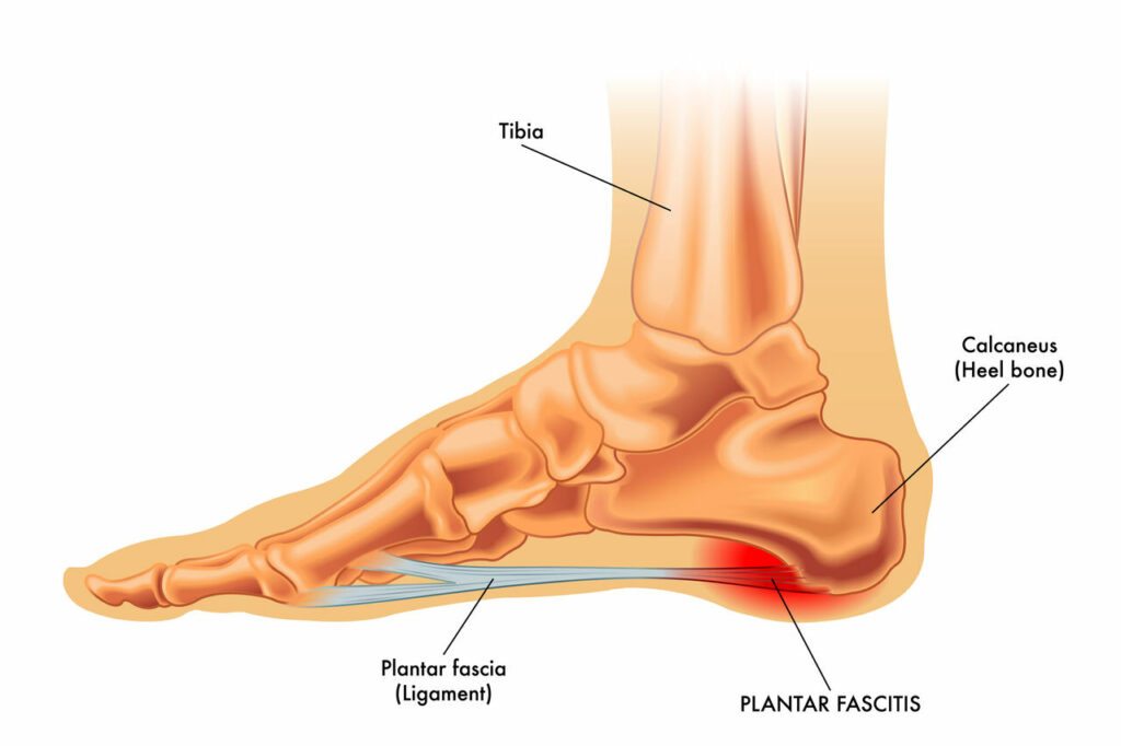 physiotherapy for plantar fasciitis
