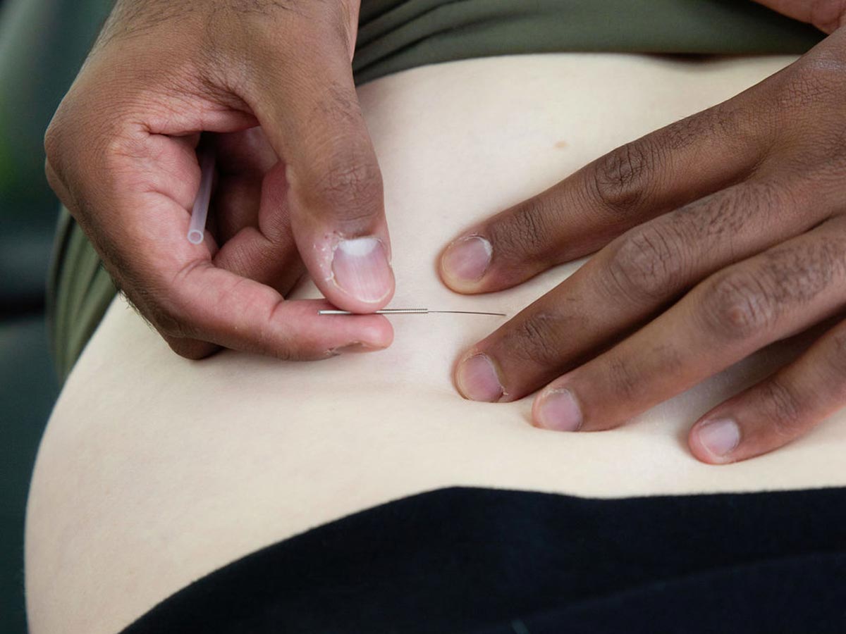apsire physiotherapy south edmonton physio aspire dry needling cropped